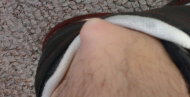 Living With Arthritis and&nbsp;Necrosis